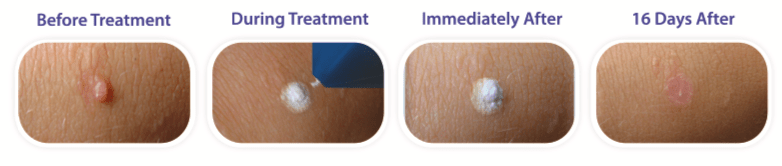 Mole, Wart, Skin Tag, Lesion Removal
